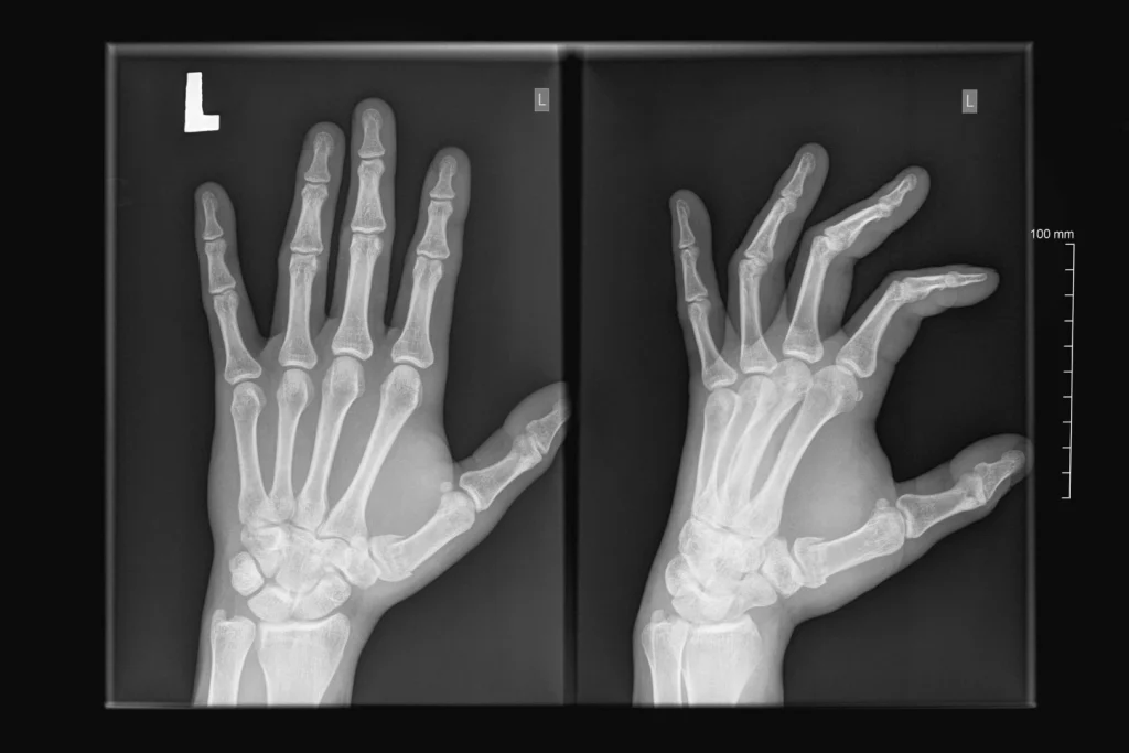 Finger Fractures Dislocations And Breaks Access Ortho
