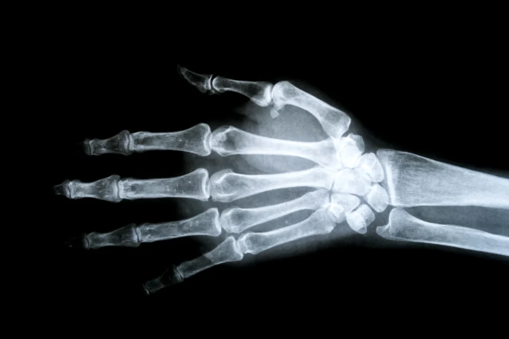Interphalangeal Joint Dislocation