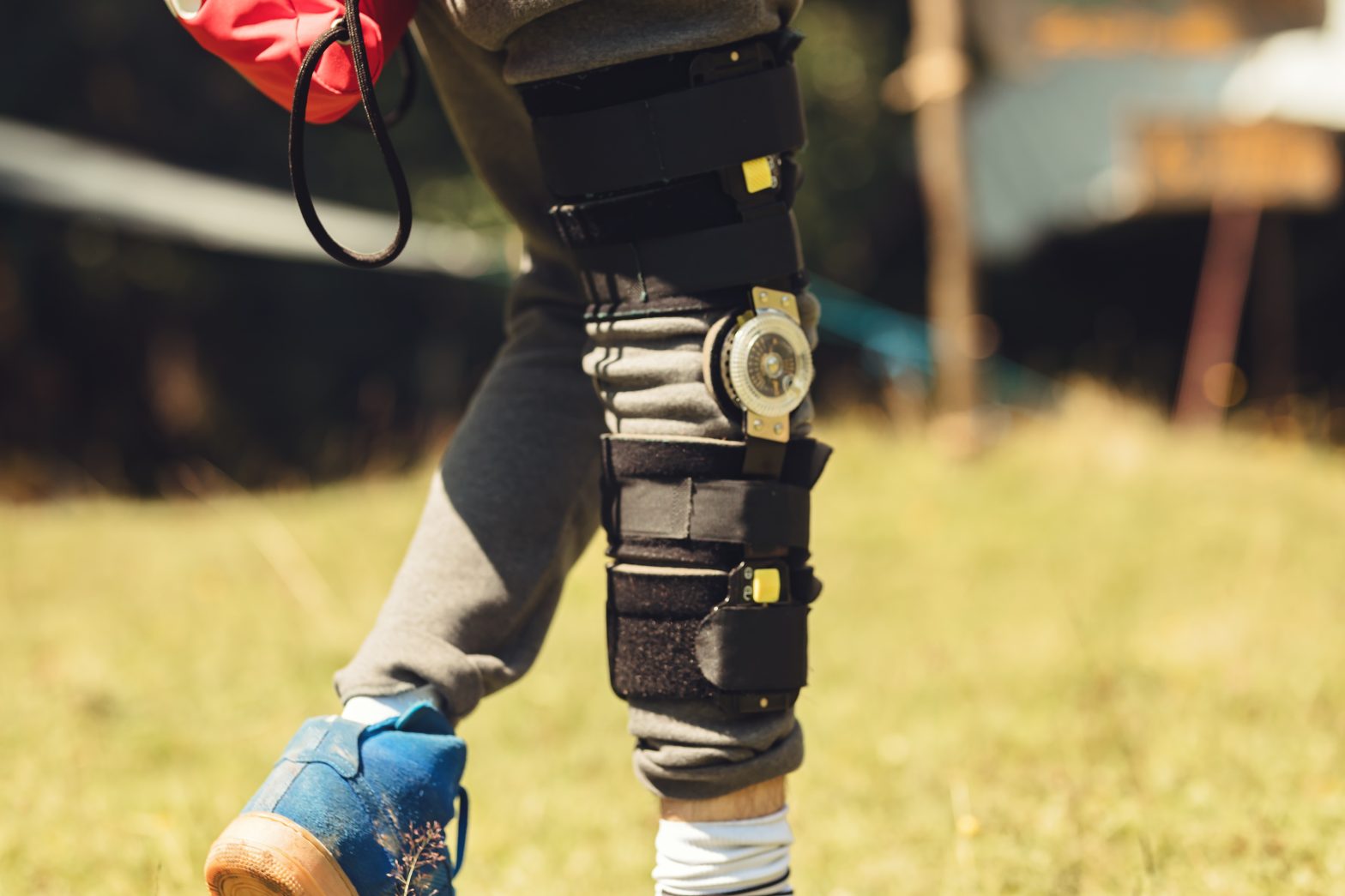 Patella / Knee Cap Fracture – Case Study — Access Ortho