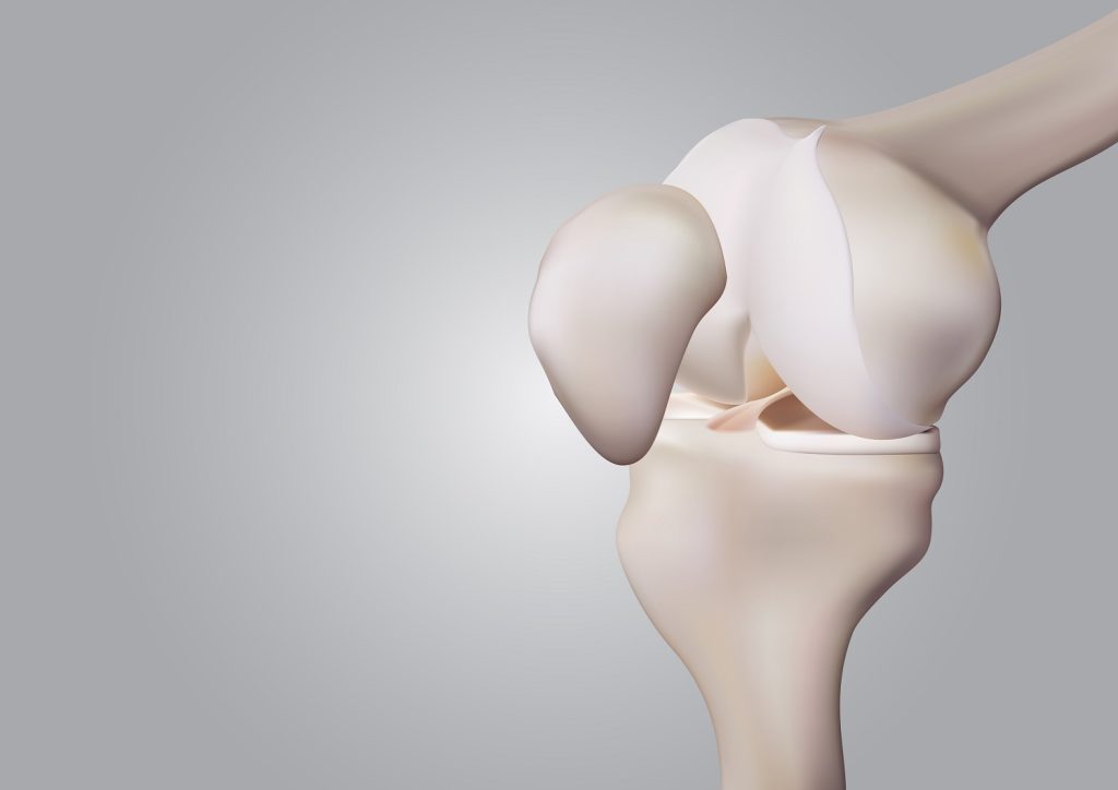 ACL Tear