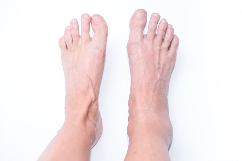 Ankle Mortise and Talar Dome Injuries